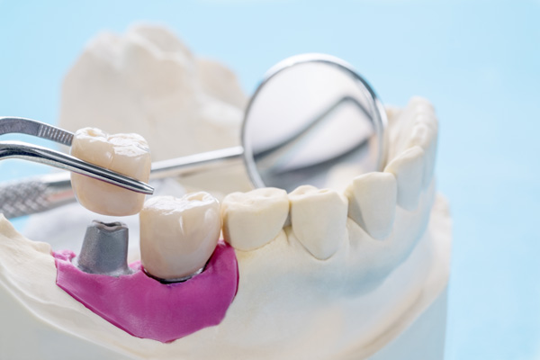 How A Tooth Is Prepared To Have A Dental Crown Restoration