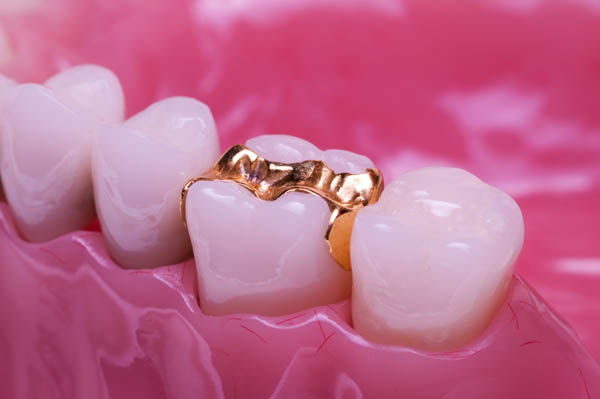 Tooth Filling Vs Dental Inlay